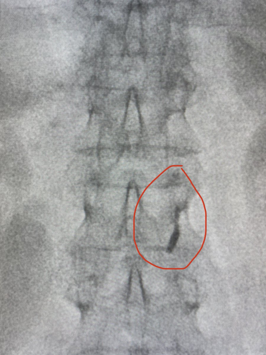 The British Society of Interventional Radiology (@bsir_news) on Twitter photo <a href="/TraineesBSIR/">BSIR Trainees (British Society of IR Trainees)</a> <a href="/SIRRFS/">SIR RFS</a> <a href="/SIR_ECS/">SIR ECS</a> <a href="/RCRadiologists/">The Royal College of Radiologists</a> <a href="/interadiologist/">Dr Sachin Modi</a> <a href="/IRdoctoruk/">Ben Maher</a> <a href="/clarelouisebent/">Clare</a> <a href="/keithppereira/">Keith Pereira MD, #VIrad</a> <a href="/CHICKVIR/">Jeffrey F. B. Chick, MD, MPH</a> <a href="/MoonJustaniah/">Almamoon Justaniah,MD, FSIR المأمون إبراهيم جستنيه</a> <a href="/narayan_karu/">Narayan Karunanithy</a> <a href="/grounds4riots/">Persian Gal 💛</a> <a href="/mo_hamady/">Mo Hamady</a> <a href="/lahinchman/">gerry osullivan</a> <a href="/IR_Doctor/">Peder E. Horner, MD Interventional Physician</a> @IR_juniors <a href="/DrAidanShaw/">Aidan Shaw</a> Indication was chronic pericardial effusion. No imaging used as far as we know. "Impressively" punctured LHV and drain in SVC via RA. Great save by my colleague <a href="/IRdoctoruk/">Ben Maher</a>. Line removed and 8F sheath placed. Venography till point of access and tract sealed with Avatene paste. <a href="/TraineesBSIR/">BSIR Trainees (British Society of IR Trainees)</a> <a href="/SIRRFS/">SIR RFS</a> <a href="/SIR_ECS/">SIR ECS</a> <a href="/RCRadiologists/">The Royal College of Radiologists</a> <a href="/interadiologist/">Dr Sachin Modi</a> <a href="/IRdoctoruk/">Ben Maher</a> <a href="/clarelouisebent/">Clare</a> <a href="/keithppereira/">Keith Pereira MD, #VIrad</a> <a href="/CHICKVIR/">Jeffrey F. B. Chick, MD, MPH</a> <a href="/MoonJustaniah/">Almamoon Justaniah,MD, FSIR المأمون إبراهيم جستنيه</a> <a href="/narayan_karu/">Narayan Karunanithy</a> <a href="/grounds4riots/">Persian Gal 💛</a> <a href="/mo_hamady/">Mo Hamady</a> <a href="/lahinchman/">gerry osullivan</a> <a href="/IR_Doctor/">Peder E. Horner, MD Interventional Physician</a> @IR_juniors <a href="/DrAidanShaw/">Aidan Shaw</a> Indication was chronic pericardial effusion. No imaging used as far as we know. "Impressively" punctured LHV and drain in SVC via RA. Great save by my colleague <a href="/IRdoctoruk/">Ben Maher</a>. Line removed and 8F sheath placed. Venography till point of access and tract sealed with Avatene paste.