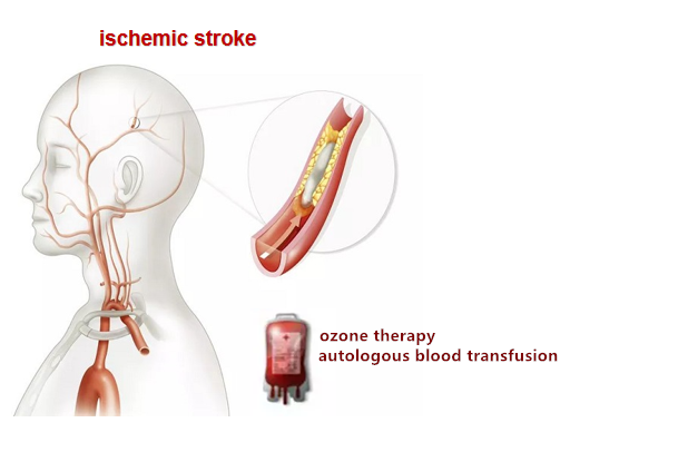 ctnsd_editor's tweet photo. #CTNSD [Study Protocol] Efficacy and safety of ozone therapy administered by autologous blood transfusion for acute ischemic stroke: study protocol for a multi-center open-label large-sample parallel randomized controlled trial
#stroke #ozonetherapy

https://t.co/AmNoIx421t https://t.co/jcS9qC86m8