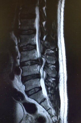 drshamikc's tweet photo. Be careful how you lift! This gentleman bent to pick up a phone when he felt a pop and lost all feeling below the waist,severe pain, and weakness in his legs. After an urgent operation to remove a huge disc fragment he’s improved! @AmritChiluwalMD @DaniloSilvaMD @JamaicaHospital https://t.co/jPOCkYQm4B