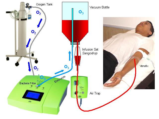MedikaptourJ's tweet photo. Ozone therapy is a procedure
the patient’s blood is mixed with ozone and oxygen extraneously and  re-infused
Ozone therapy is used for
Diabetes mellitus  
Adjuvant tumor therapy 
bacteria and virus infection 

https://t.co/XcShY5NCwA
james@medikaptour.com
#medikaptour https://t.co/BH7dhHe8Tv
