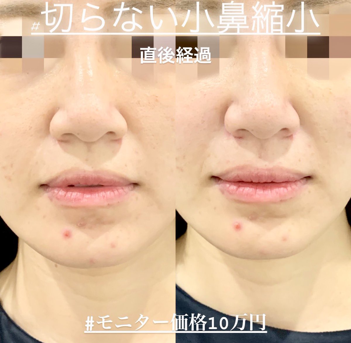 糸リフト 二重整形 鼻整形 ルラ美容クリニック院長 武内大 切らない小鼻縮小術 モニター価格10万円 直後経過です 小鼻が小さくなっていることが分かります 5分の施術でこの変化です また仕上がりは0 5mm程度から調整可能で切らないため