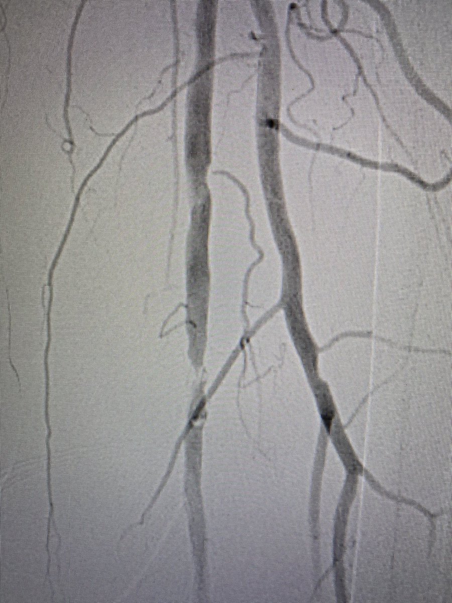 BhallaMd's tweet photo. Calcified mid-SFA CTO - treated with 2 mm Auryon laser and 6mm 0.18 DCB. #calciumsucks #PAD #Auryon #Lutonix @BardPV @angiodynamics https://t.co/oYrIZcfacp