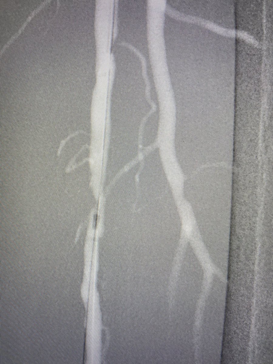 BhallaMd's tweet photo. Calcified mid-SFA CTO - treated with 2 mm Auryon laser and 6mm 0.18 DCB. #calciumsucks #PAD #Auryon #Lutonix @BardPV @angiodynamics https://t.co/oYrIZcfacp