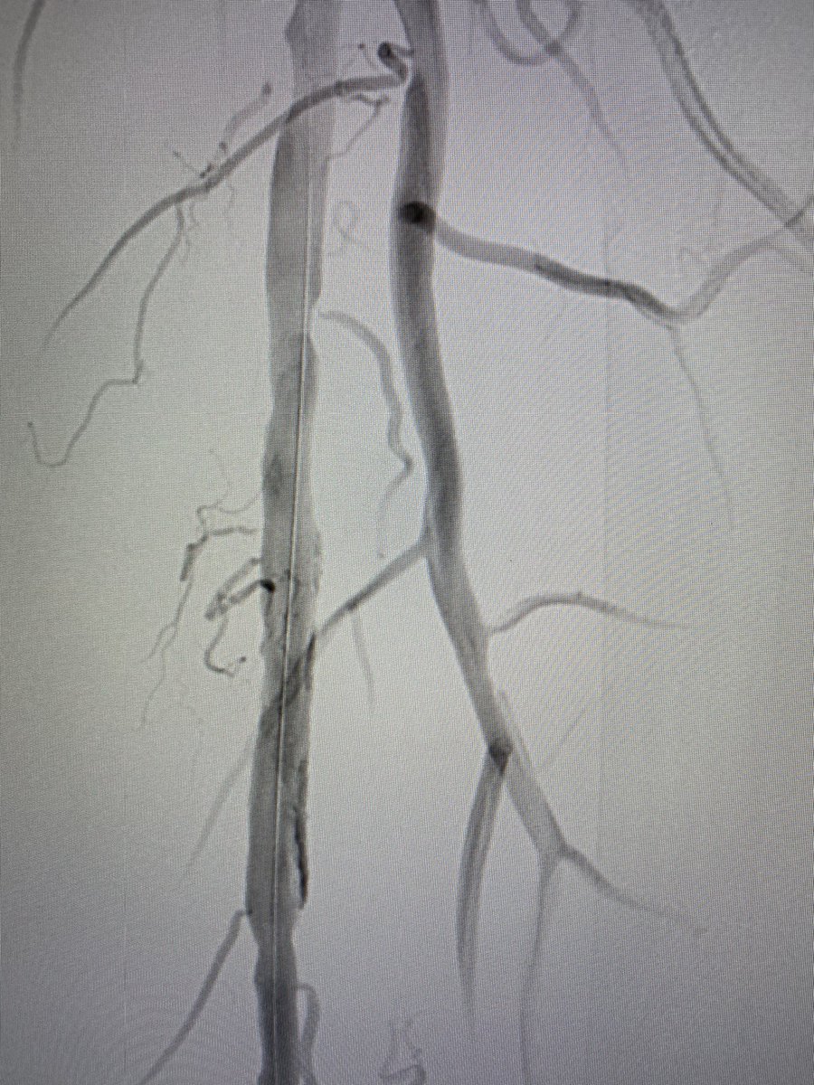 BhallaMd's tweet photo. Calcified mid-SFA CTO - treated with 2 mm Auryon laser and 6mm 0.18 DCB. #calciumsucks #PAD #Auryon #Lutonix @BardPV @angiodynamics https://t.co/oYrIZcfacp