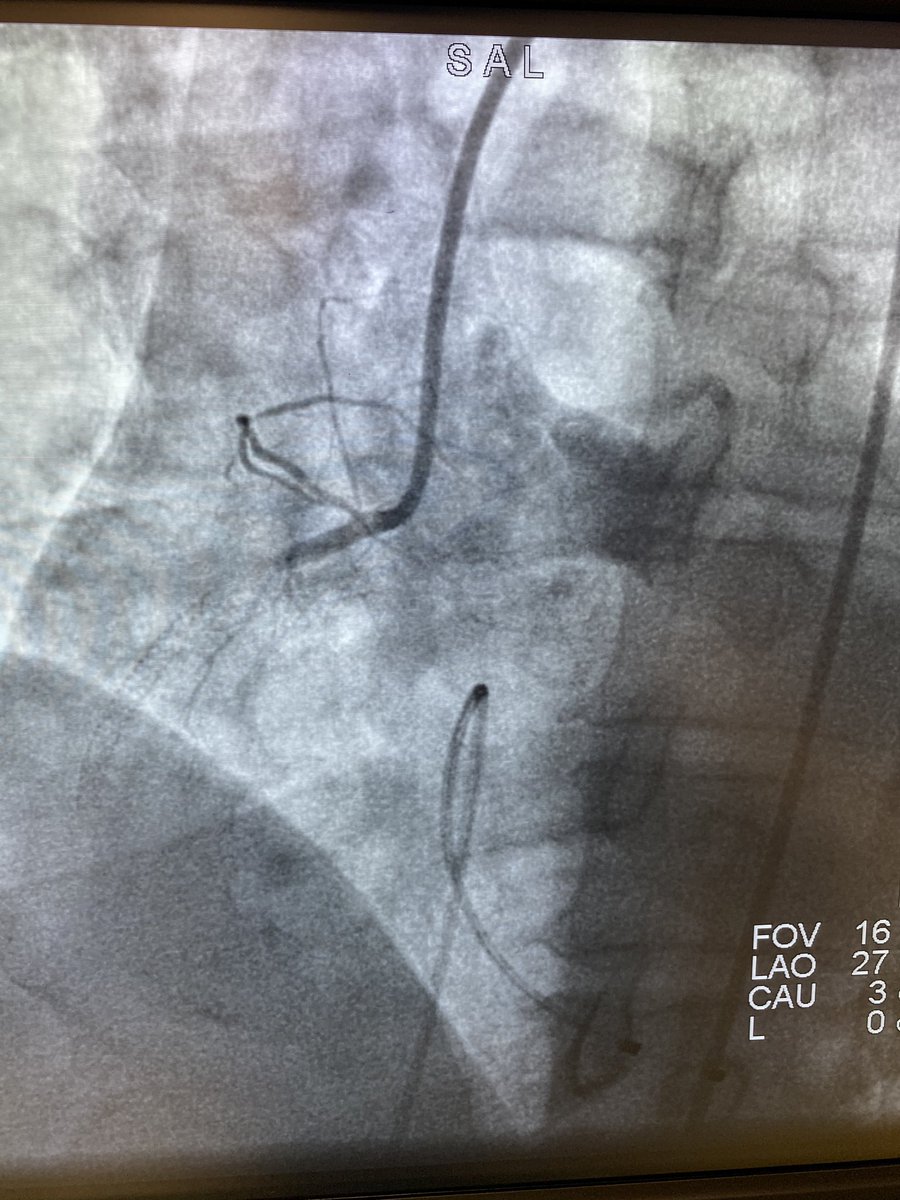 BhallaMd's tweet photo. Saturday evening. COVID +, D2B 51 minutes. #STEMI #Synergy @HCAhealthcare @BSCCardiology https://t.co/WGh6DuALdX