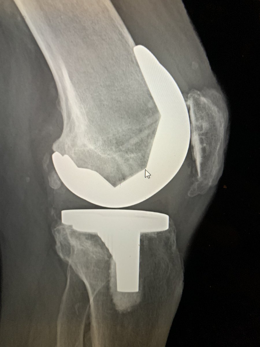 Xrays show a well fixed Scorpio PS TKA in neutral alignment. Scorpio has a low profile box and can be mistaken for CR.