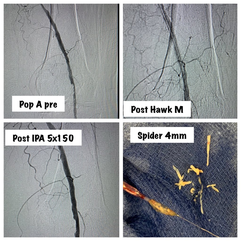 BhallaMd's tweet photo. Spider Fx for single vessel runoff, saves the day. #spider #CLI @MedtronicAPV https://t.co/fQNMOorjFw