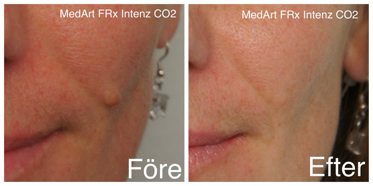 a_medart's tweet photo. Treatment of dermal nevus removed by MedArt FRx Intenz CO2
One Treatment, Fast and Effective. 👍👌🙏🏻💐💐 
Read more: https://t.co/gE6pJKJv9Q 
#moleskine #nevus #nevuslaser https://t.co/QXafJTS2S3