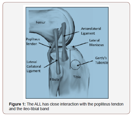 IrisPublishers's tweet photo. Lateral Extraarticular Tenodesis in Combination with ACL Reconstruction: Indications, Technique Description by Sebastian Orduna in #GJOR @IrisPublishers - #IrisPublishers
https://t.co/FfUY4DgLwW https://t.co/p43yHl2PPO