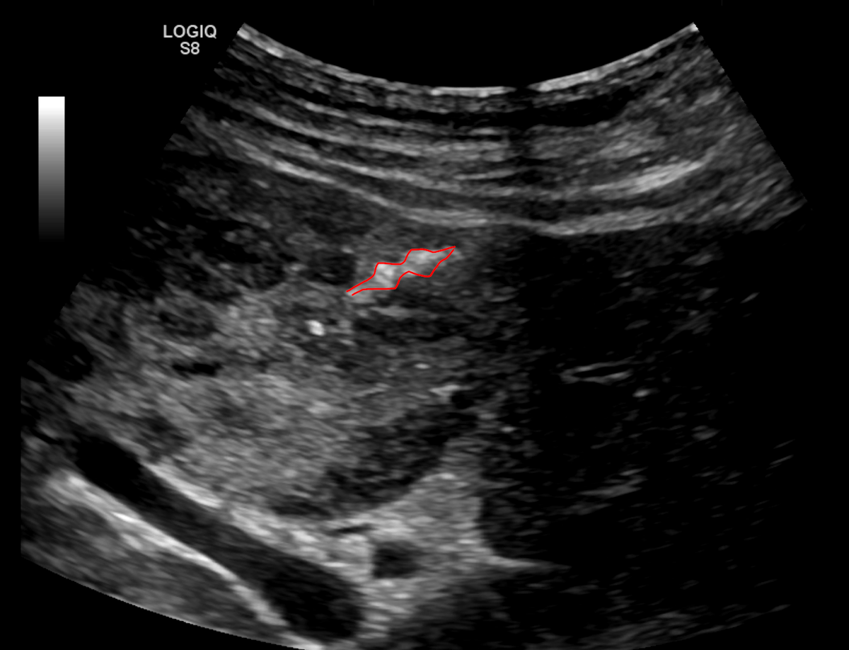 NshRadiology's tweet photo. Using a type IV #VascularPlug to occlude a biopsy tract along with gelfoam in a patient with hardly correctable  coagulopathy and multiple hepatic lesions as part of #Oncology work up #Irad #Intervention #Makkah https://t.co/kfoGfjPCK3