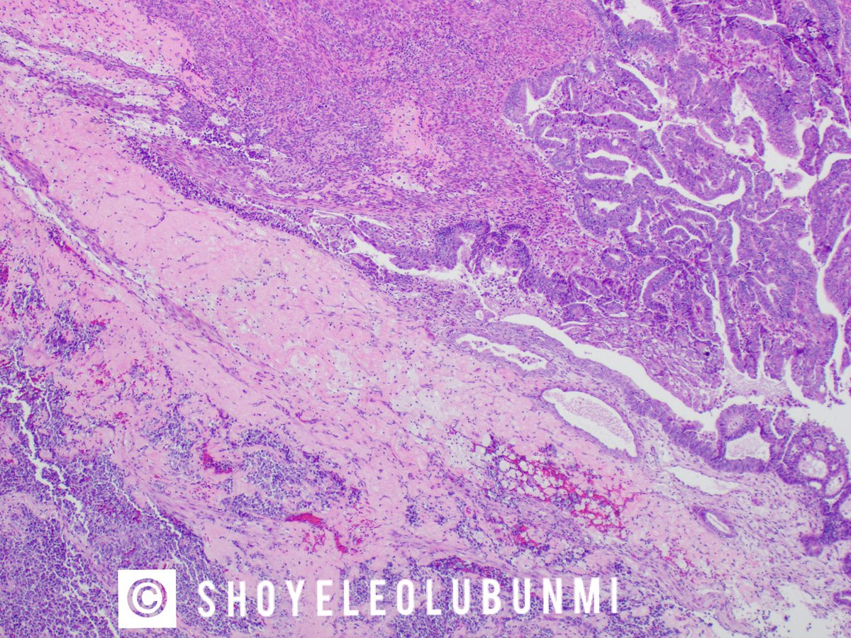 ShoyeleOlubunmi's tweet photo. #PathPourri
Case 2: Hysterectomy specimen, middle-aged patient.
Diagnosis?
What FIGO grade would you assign to this?
FIGO grade 1/2/3 or none? https://t.co/QVouh8ALIa