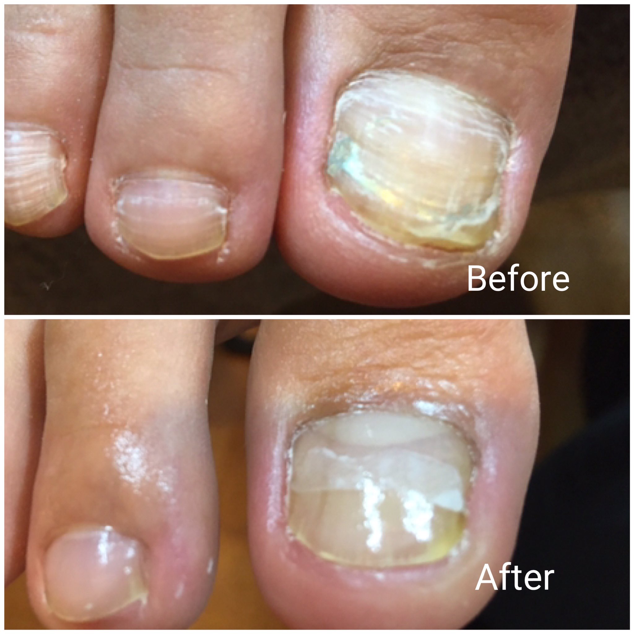 末広町駅 徒歩１分の痛くない巻き爪ケアサロン Makizume Wrnail Twitter