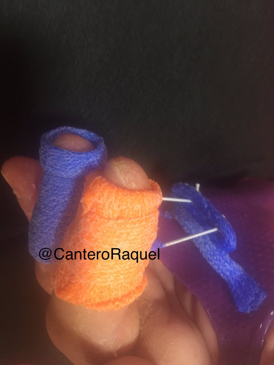 CanteroRaquel's tweet photo. Ortesis para mejorar movilidad de los dedos. Sabes que puedes cosntruir la parte dinámica con orficast y ahorrar tiempo y dinero? @HandOrthosis #handtherapy https://t.co/IASBI1YV1F