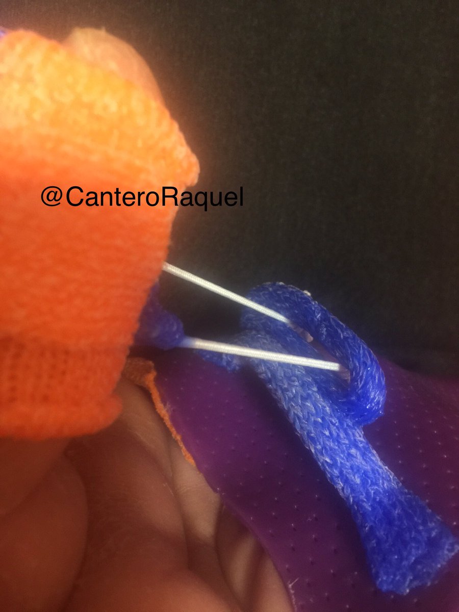 CanteroRaquel's tweet photo. Ortesis para mejorar movilidad de los dedos. Sabes que puedes cosntruir la parte dinámica con orficast y ahorrar tiempo y dinero? @HandOrthosis #handtherapy https://t.co/IASBI1YV1F