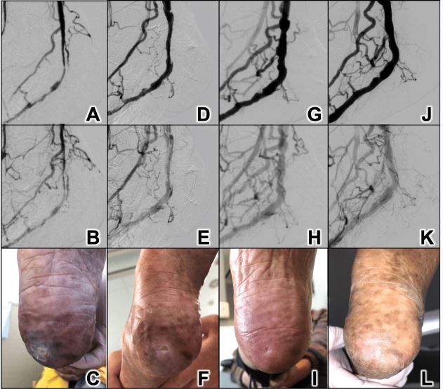 JACCJournals's tweet photo. In this case, @tatsuya_nakama and colleagues showed the temporal angiographic progression of reverse blood supply after percutaneous deep venous arterialization to treat #CLI, which led to healing of the ulcer. Read more #JACCINT: https://t.co/yRpthmEb7K https://t.co/HRx53zdIKn