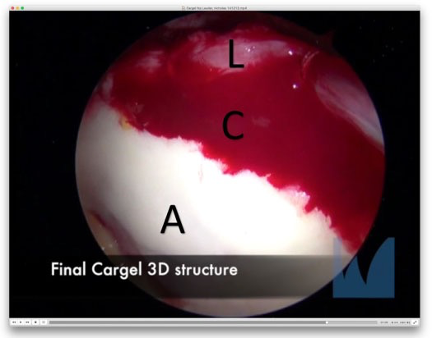 dalsportsmed's tweet photo. Do you know the arthroscopic treatment of #ChondralAcetabularDefects with #CarGel demonstrates a satisfactory safety profile, even for those with very large chondral defect sizes?
Check it here: https://t.co/C3BVFsArGA
@OJSM_SportsMed @dalsurgresearch @DalHealth @SportsMedMD https://t.co/t3VQYzF3es