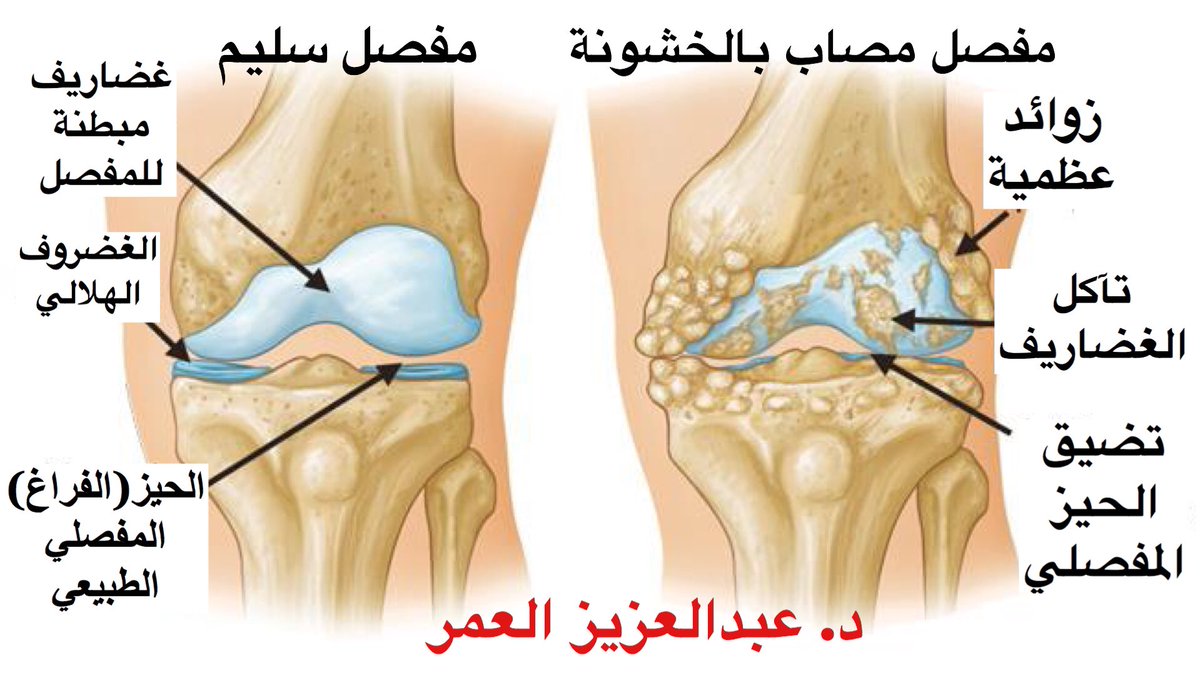 (١)
تحت هذه التغريدة ساتحدث عن العلاج التحفظي (غير جراحي) لخشونة مفصل الركبة.

ماهي أنواع العلاجات التحفظية؟
هل هناك طرق غير جراحية فعالة في تخفيف أعراض الخشونة؟

#خشونة_الركبة
#خشونة