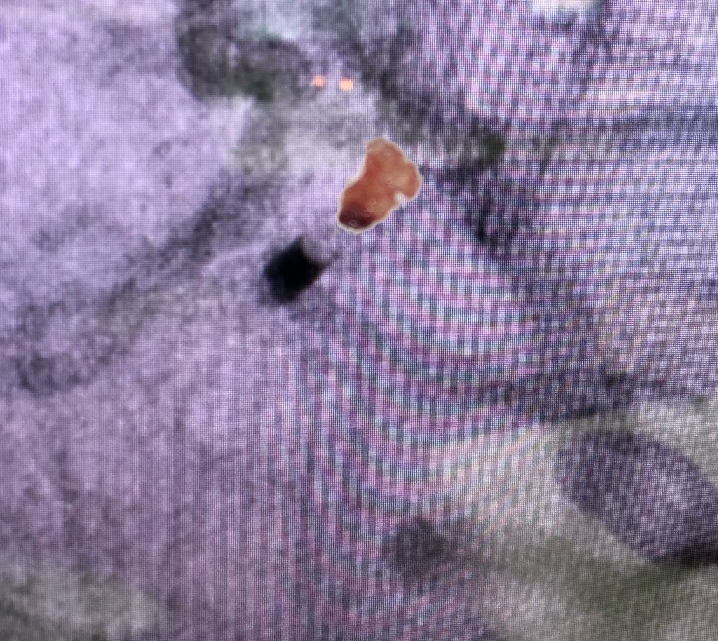 ikeafonso1's tweet photo. Imaging of a thrombus by angiography, and the real thrombus extracted. The proximal surface of the thrombus was no so round after ADAPT. #stroke #thrombectomy #LeaveNoELVObehind https://t.co/pUtwc5vAt7