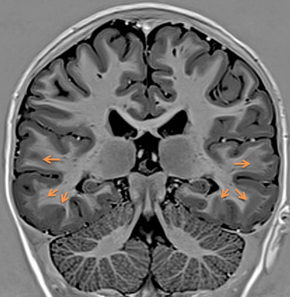 EpilepsiaRuber's tweet photo. Algunas malformaciones del desarrollo cortical se relacionan con alteraciones genéticas concretas. Esta doble corteza-paquigiria temporal (flechas) es por una variante patogénica en el gen PAFAH1B1 (LIS-1) y la gravedad de la maformación tiene un gradiente post-ant.
#Epiteca https://t.co/kbGvtPl7pm
