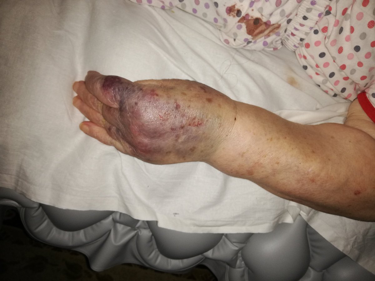 <a href="/saglikbakanligi/">T.C. Sağlık Bakanlığı</a> <a href="/drfahrettinkoca/">Dr. Fahrettin Koca</a> annem yatalak hasta olduğu için evde sağlık bakım doktoru geldi. Sol kolunun rahatsız olduğunu söylemize rağmen ısrarla 'hemşire işini bilir' diyerek elinin üzerinden kan alındı. Hastamızın son durumu böyle. Lütfen gereken yapılsın.