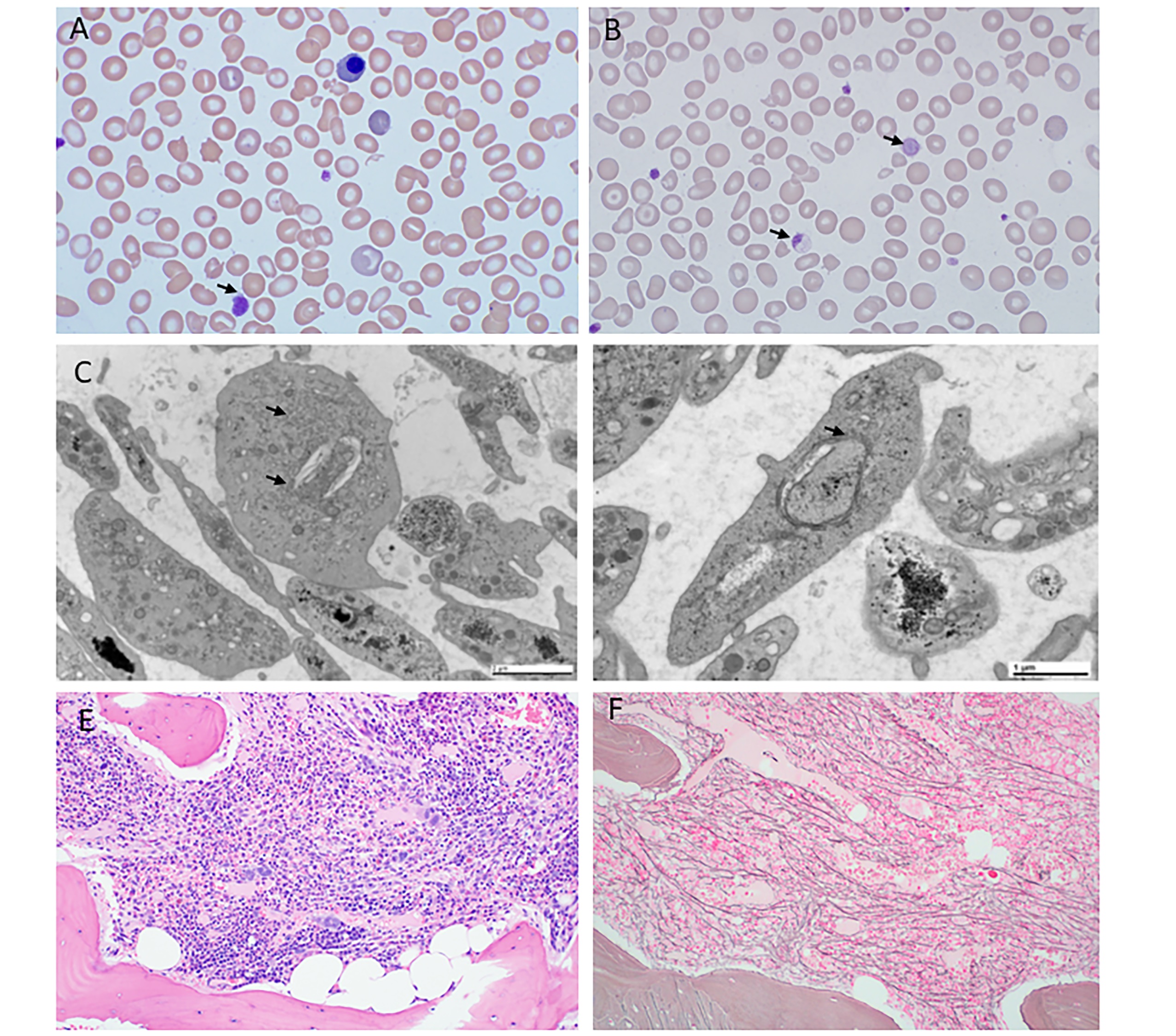 Mrinal Patnaik on Twitter "35 Y with macrothrombocytopenia and easy