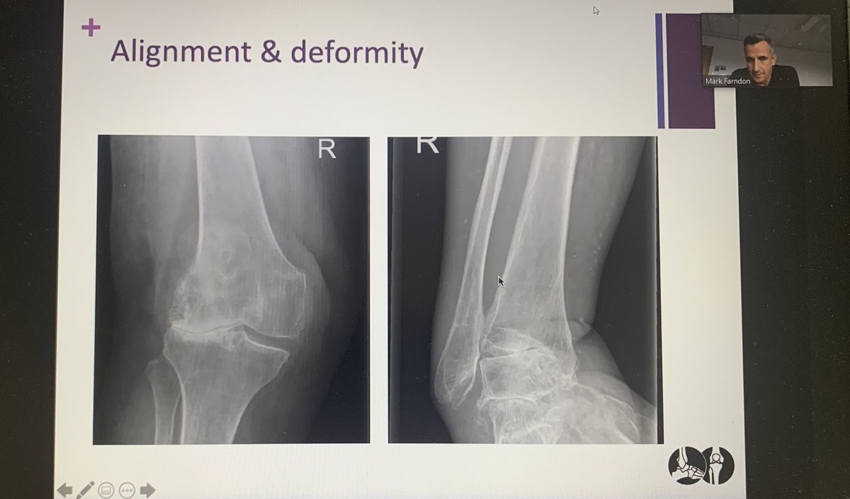 woodsy_simon's tweet image. Many thanks Mr Farndon @feet2knees  for @YOTS07658602’s teaching session today cover ankle OA. Lots of practical clinical pearls and some clarity on the TAR v/s Fusion debate