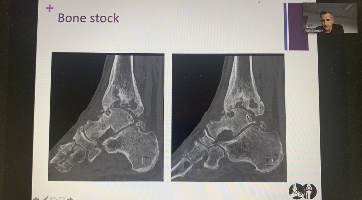 woodsy_simon's tweet image. Many thanks Mr Farndon @feet2knees  for @YOTS07658602’s teaching session today cover ankle OA. Lots of practical clinical pearls and some clarity on the TAR v/s Fusion debate