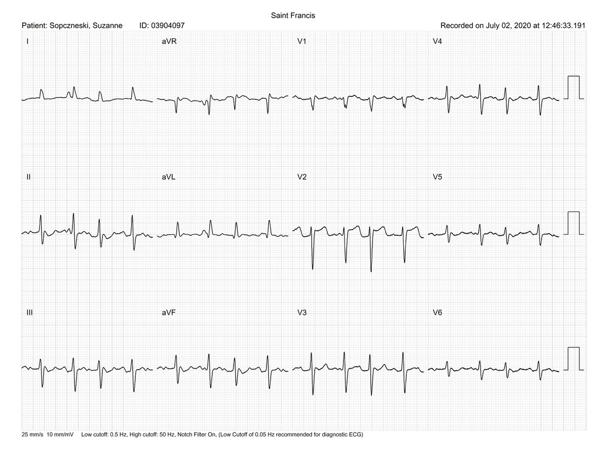 jdellorf's tweet photo. Post surgical maze flutter terminated with cryoballoon at LSPV. #HDgrid #EPeeps #zerofluoro

https://t.co/stu6lf65xp https://t.co/fhxjTtSvhP