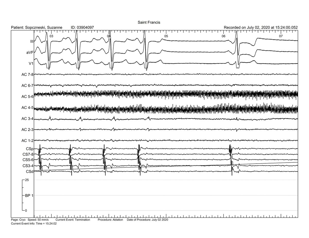 jdellorf's tweet photo. Post surgical maze flutter terminated with cryoballoon at LSPV. #HDgrid #EPeeps #zerofluoro

https://t.co/stu6lf65xp https://t.co/fhxjTtSvhP