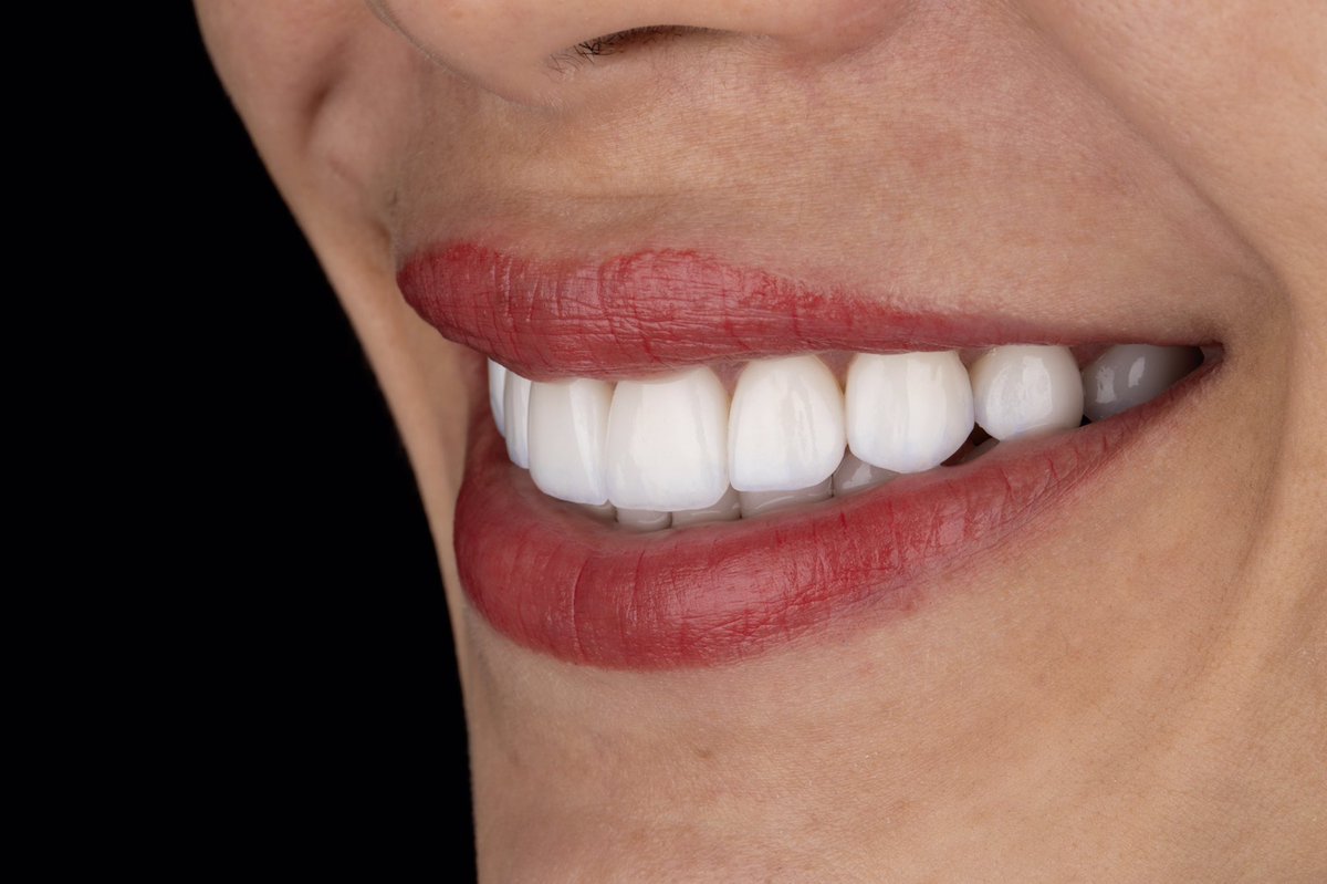 DRANTONIOLEON's tweet photo. #dentalveneers #sonrisas #smile https://t.co/1GXxYGUsVC