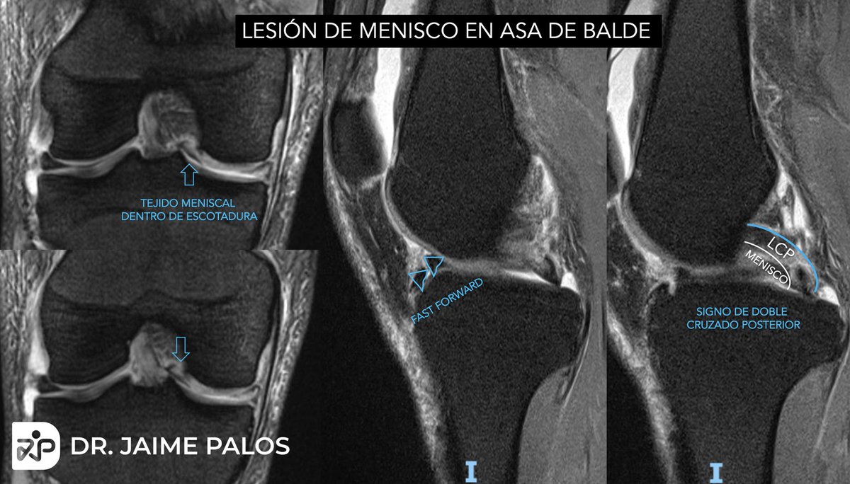 •Lesión de Menisco en Asa de Balde•
🦵🏾
#savethemeniscus #rodilla #menisco #orthotwitter #knee #arthroscopy #buckethandle #MRI #fastforward
