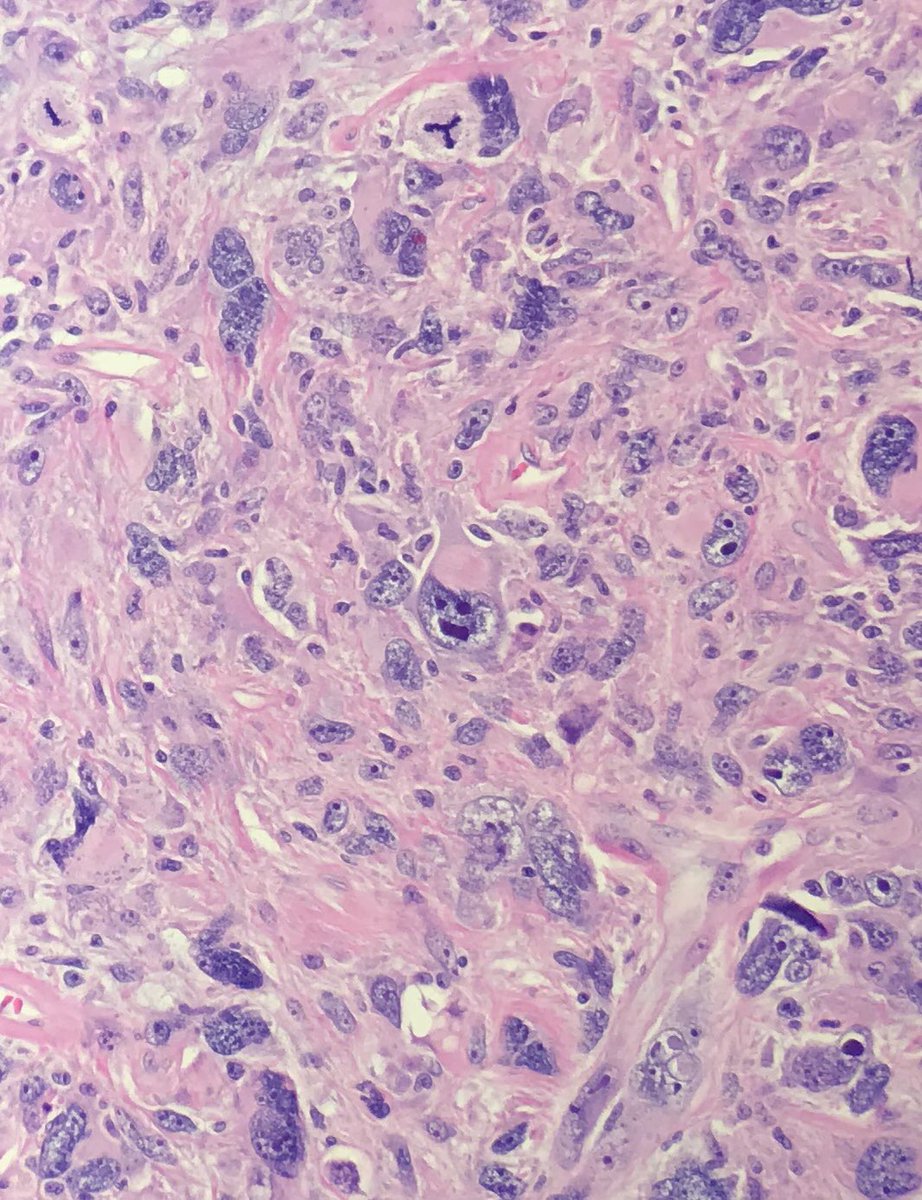 JBrowningMD's tweet photo. A slightly frightened sarcoma smiley face... seems fitting for my first case in fellowship! https://t.co/wHef3q5Amx