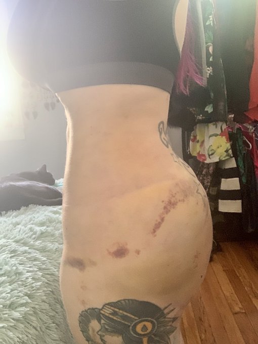 Surgery has caused all the blood to settle in my hips and bum. But I&rsquo;m looking and feeling better day<a href="/tag/votehimout2020"class="tags"><span>#votehimout2020</span></a>