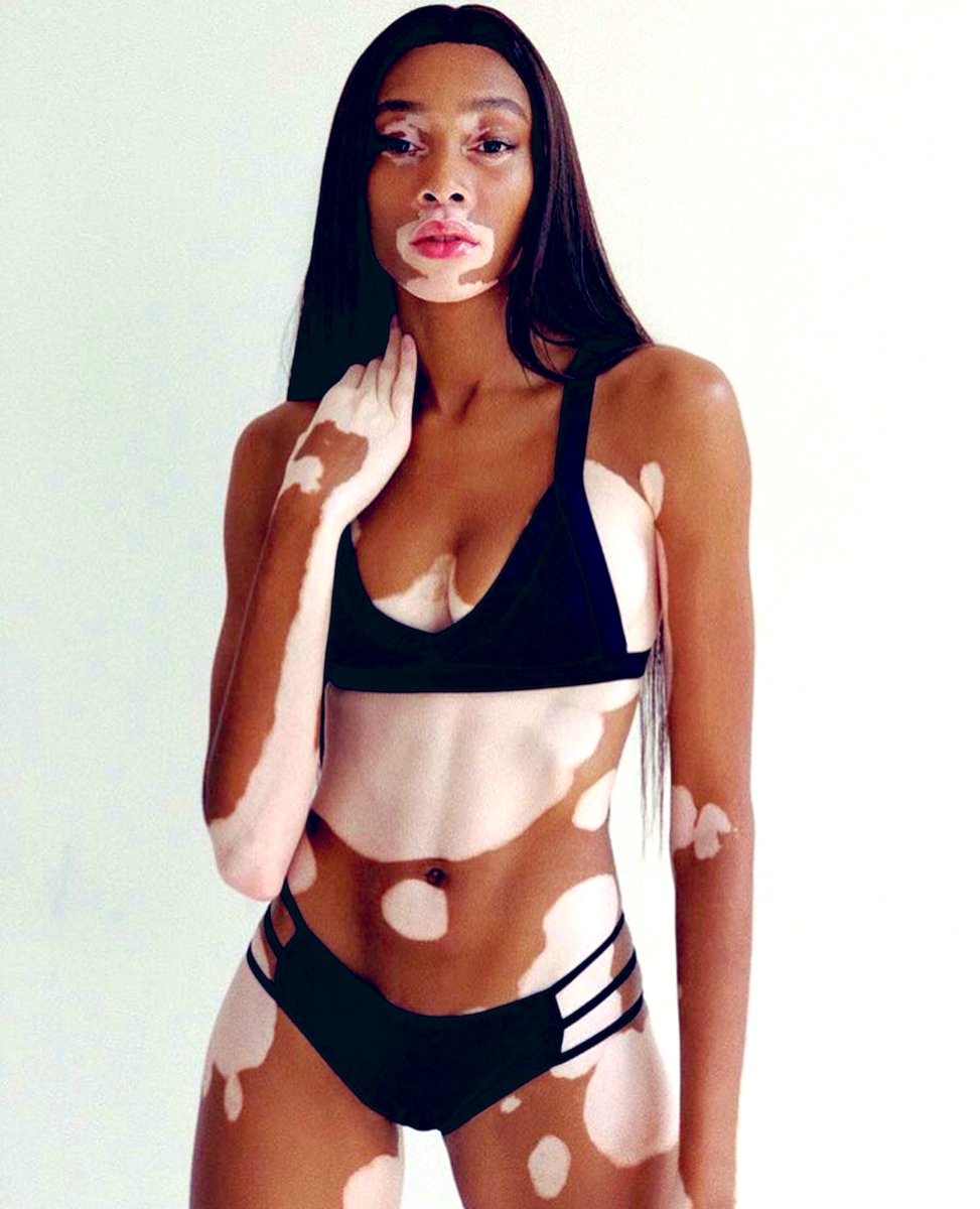 ShaySoDangerous's tweet photo. Y’all accept Winnie Harlow but deny Michael Jackson ? They both have vitiligo and they’re BOTH black .. https://t.co/pZrHoVhHKo