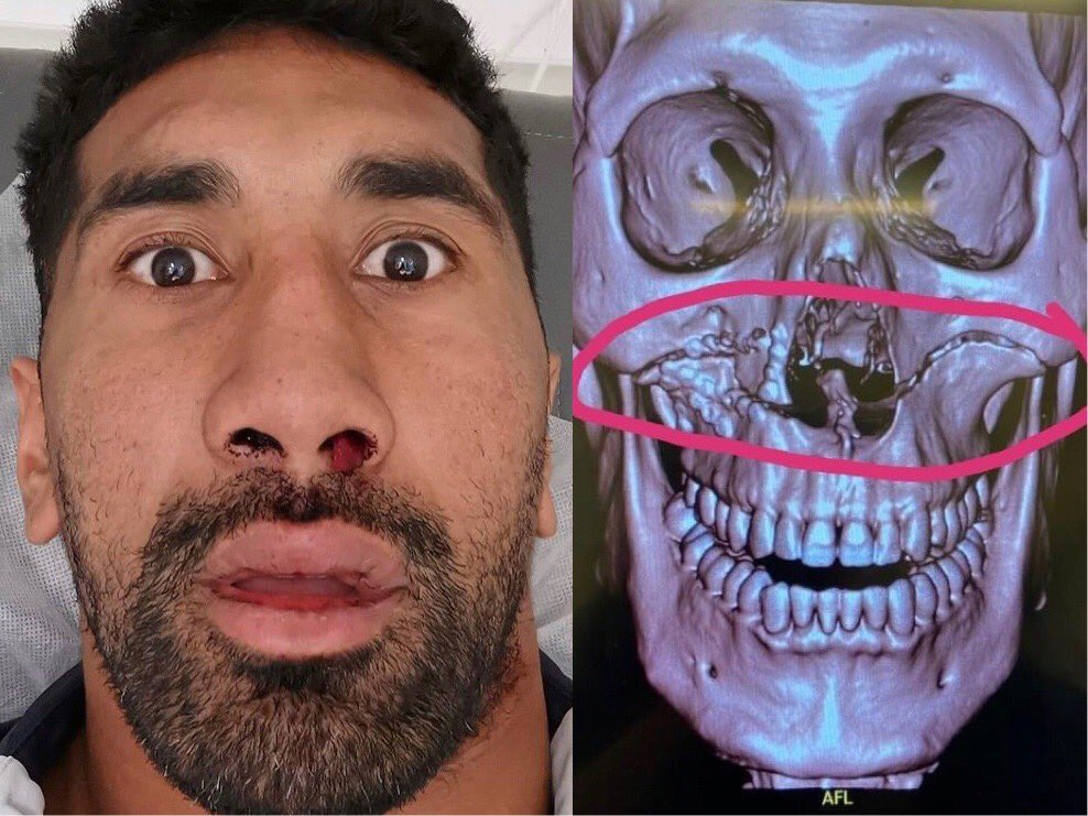 nrlphysio's tweet photo. Unfortunately scans revealed a significant facial fracture for Sia Soliola, is now facing surgery. Fracture of this nature usually requires at least 6-8 weeks on the sideline but possibly much more depending on type of surgery required (worst case 3-4 months) https://t.co/RELySfDnR5