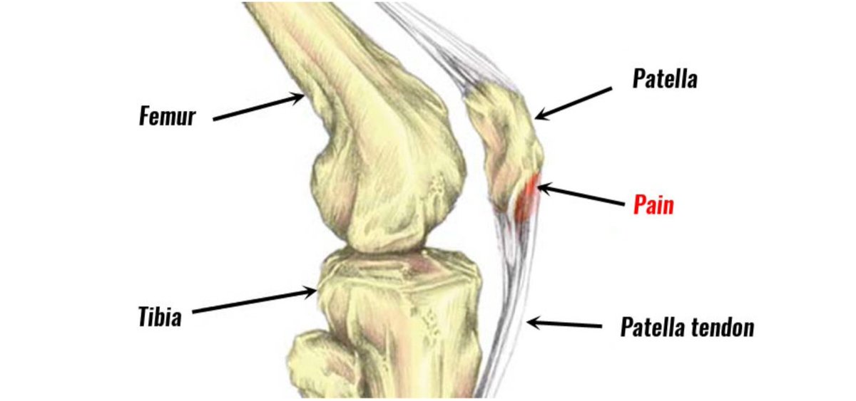 Tendinosis produces pain, stiffness and swelling in a tendon. However, it usually develops gradually as a result of long-term overuse—after many microtears over a long period of time.