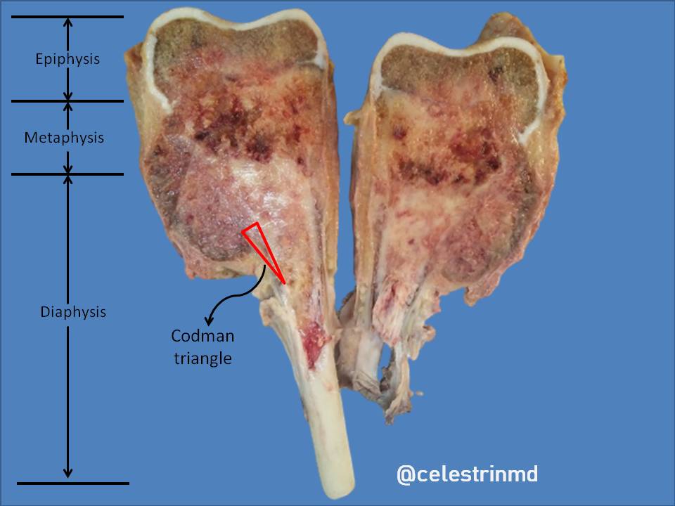 Pointers on typical gross findings of osteosarcoma!Usually metaphyseal in long bones (90%)Tumor frequently breaks through the cortex and lifts the periosteum,Codman triangle: triangular shadow between the cortex and raised ends of periosteum