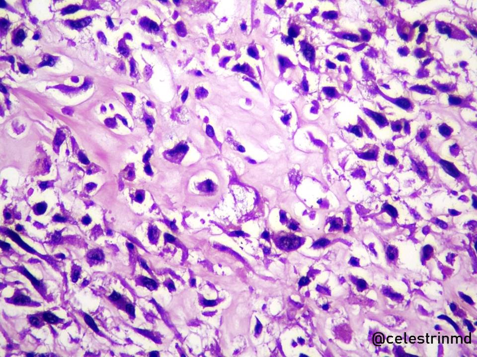 Histopathology of osteosarcoma:Essential to the diagnosis: bone production (osteoid formation) by the tumor cells; lace-like pattern High grade: neoplastic cells with severe anaplasia and pleomorphism, abundant (and atypical) mitotic figures