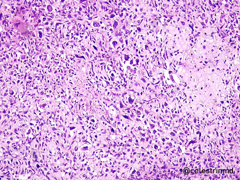 Histopathology of osteosarcoma:Essential to the diagnosis: bone production (osteoid formation) by the tumor cells; lace-like pattern High grade: neoplastic cells with severe anaplasia and pleomorphism, abundant (and atypical) mitotic figures