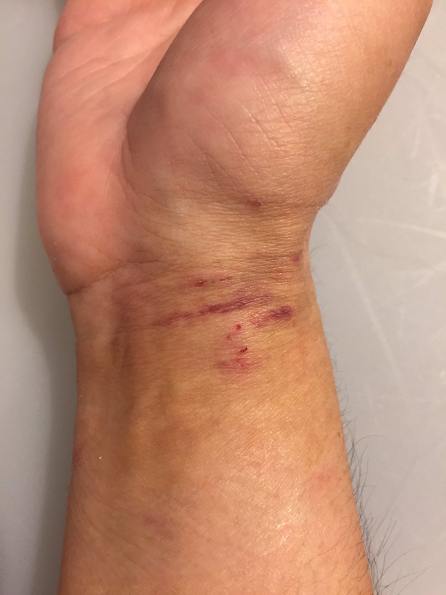 25. Finally (literally) ripped the 2 pressure bandages off my wrist and neck. It would have been easier in the shower but I was itchy and didn’t want to wait. My neck looks a bit like I’ve been attacked by a vampire. 