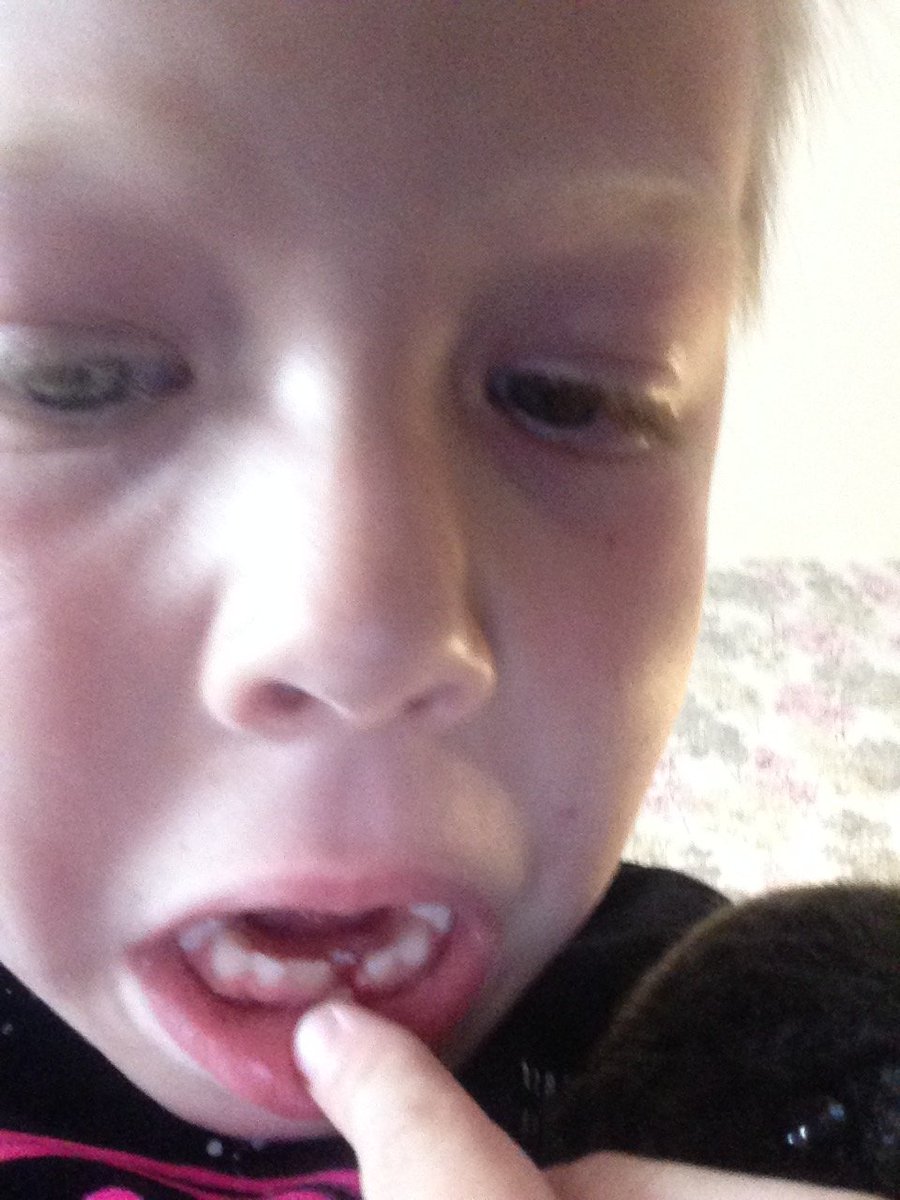 # tooth coming out!