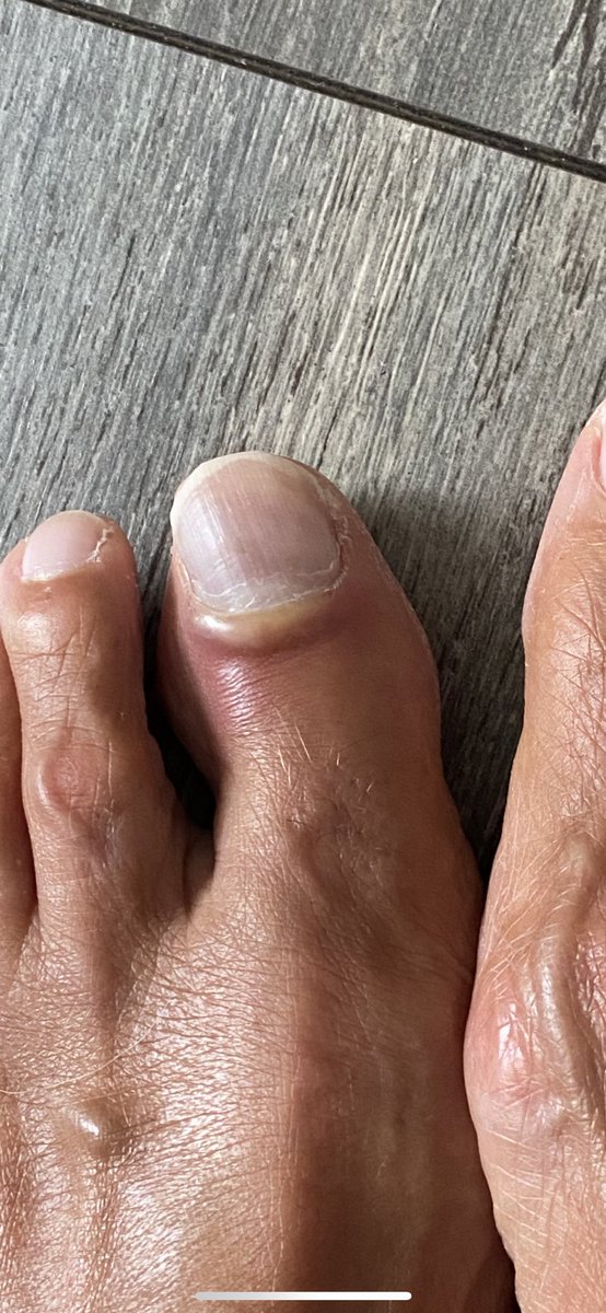 Nattyvic87's tweet photo. @adidasUK My Mum purchased some of your trainers... after wearing them for a few hours, this is what they have done to her left toe!! Her toe was absolutely fine before hand too! Please advise on how she goes about getting a refund! https://t.co/ShGheHWocW