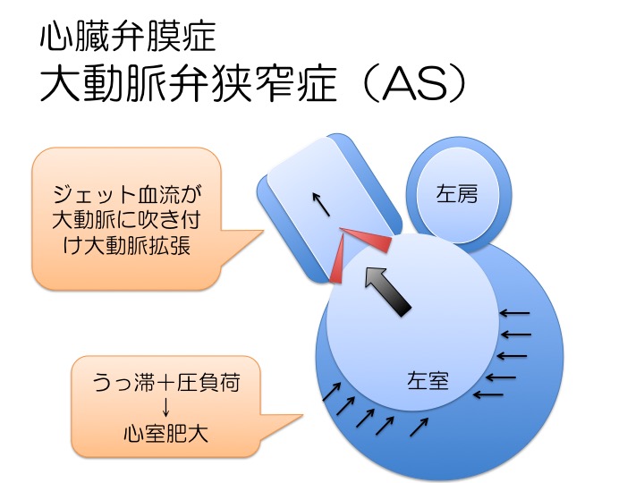 けーたろー Rn Msn Cns 慢性疾患看護 33 弁膜症のリモデリングイメージ 基礎疾患の理解は心不全の理解に必須です 弁膜症といっても色々あるんですよね 100日後にリハビリ看護がマスターできる T Co Dvehxbhojy Twitter けーたろー Rn Msn Cns 慢性疾患看護 33 弁膜症のリモデリングイメージ 基礎疾患の理解は心不全の理解に必須です 弁膜症といっても色々あるんですよね 100日後にリハビリ看護がマスターできる T Co Dvehxbhojy Twitter