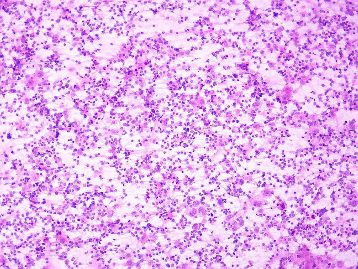GeronimoJrLapac's tweet photo. #cytopath 
#pathology
Dx ? https://t.co/FMFJn14JCs