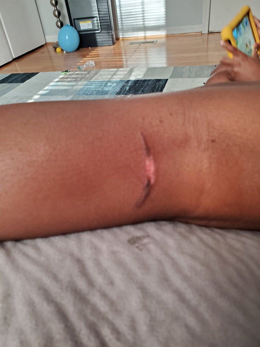 CoachKenya's tweet photo. @Ford My 7 yr old kid got burned from one of the exhaust pipes on the back of my husband's new Ford Flex. https://t.co/qCtm4rwNOe