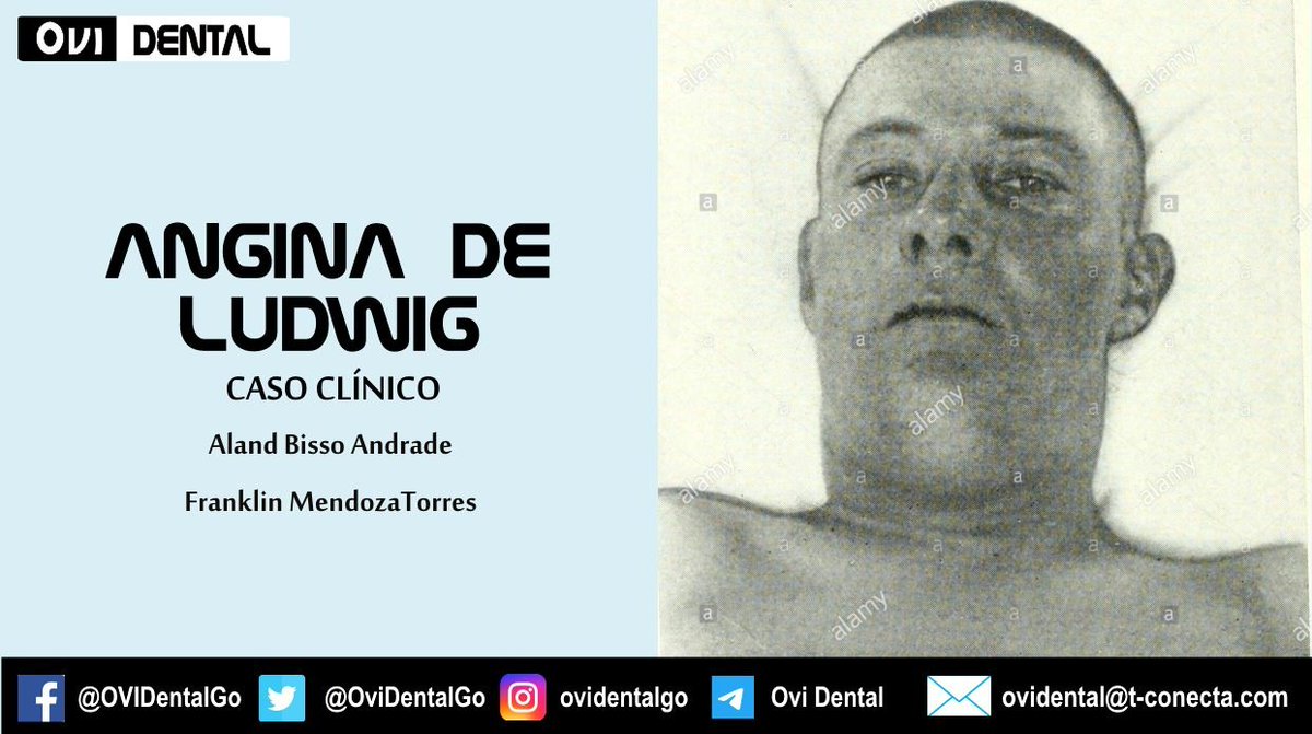 OviDentalGo's tweet photo. Angina de Ludwig. Patología infecciosa que afecta el suelo de la boca, avanzando hacia los espacios submandibulares, sublinguales y submentonianos, progresando hacia la vía aérea, pudiendo causar colapso, falla ventilatoria y muerte.
CASO CLÍNICO 👉 https://t.co/K2mNjJit4m https://t.co/N8ql0u4yDw