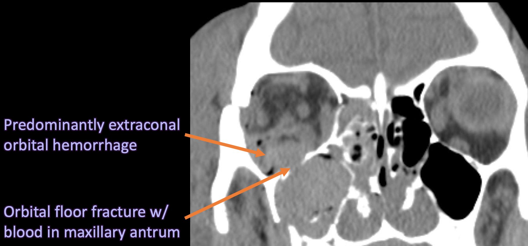 Acute Orbital Compartment Syndrome Due To Traumatic H vrogue.co