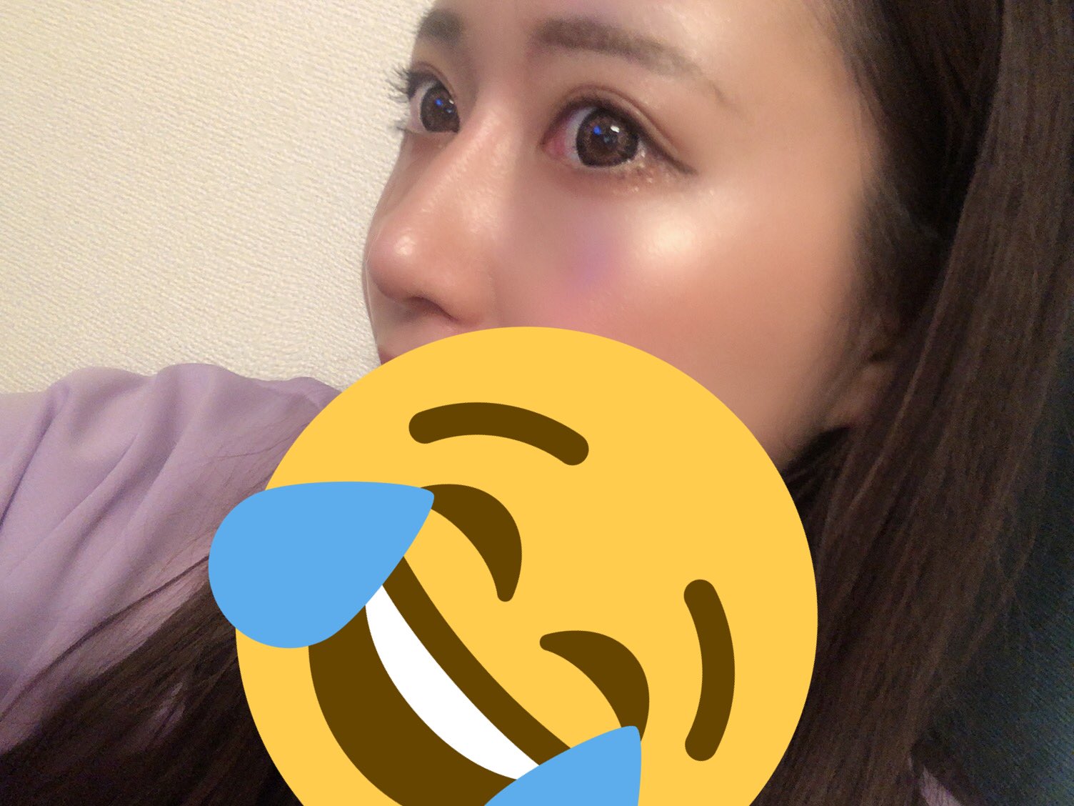 おでんちゃん 全切開 鼻プロテ On Twitter 鼻 整形から約１ヶ月経ちました 腫れていて太かった鼻筋も落ち着いてきて だいぶすっきりしてきました 痛みや違和感 もほぼなくなってきています 鼻先は触るとまだ少しだけ痛いです 鼻プロテーゼ 鼻尖形成 鼻整形