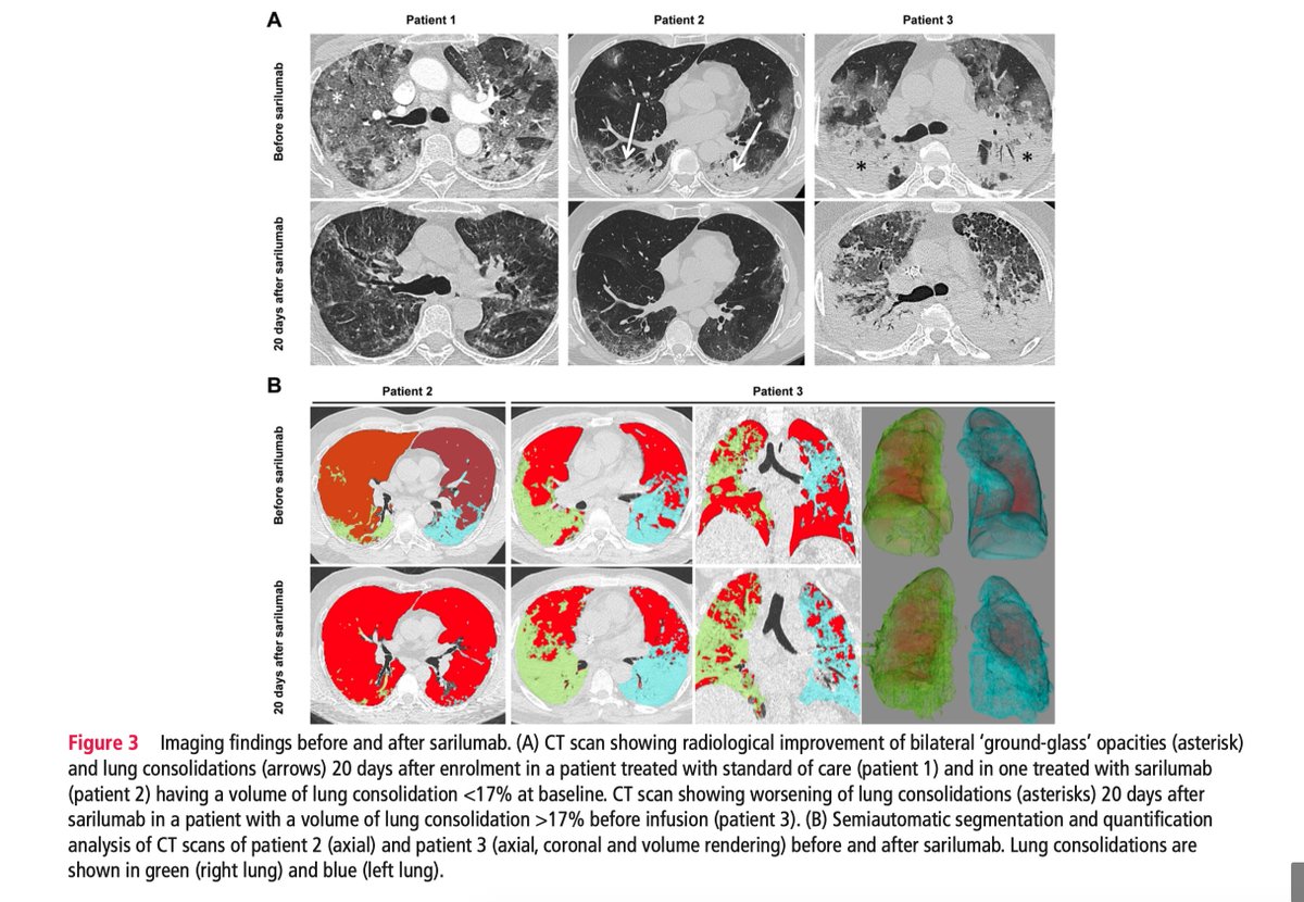 SRAnesthesiaICU's tweet photo. Our study on @ARD_BMJ indicates that sarilumab is safe and effective in #COVID19 patients with a low percentage of consolidation at CT scan and suggests that quantification of lung consolidation is important in future trials with immunosuppressant drugs.

#COVID19FOAM https://t.co/j1573Ytb7y