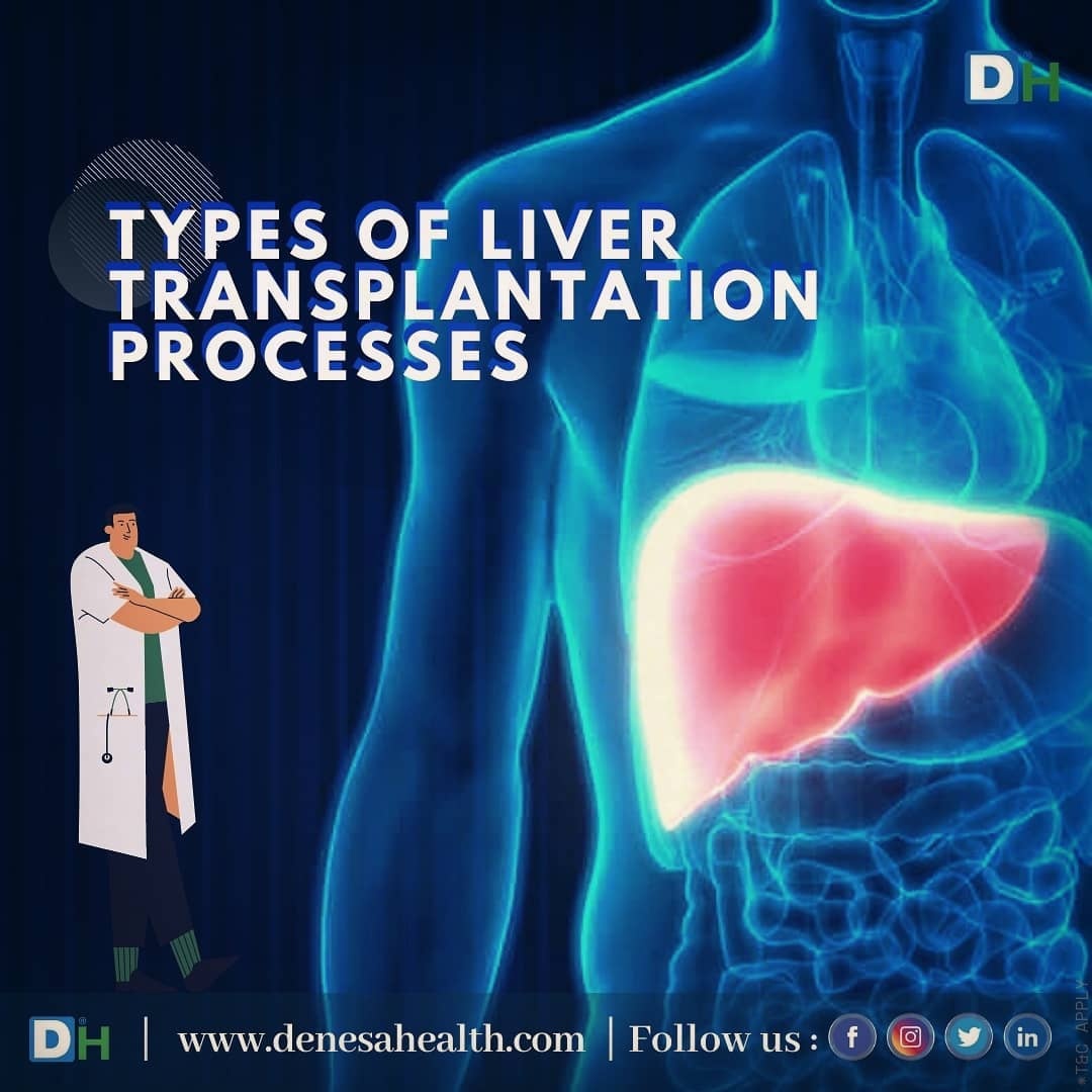 DenesaHealth's tweet photo. Types of #LiverTransplantation :
A #Liver is one of the essential parts of the body. Any issues in the function of the liver can have adverse effects on the body.  https://t.co/42Hyc0ycuq

#LiverProblems #keepingLiverhealthy #protectyourLiver #HealthyLiver #DenesaHealth #CLD https://t.co/dfcFBqSeo2